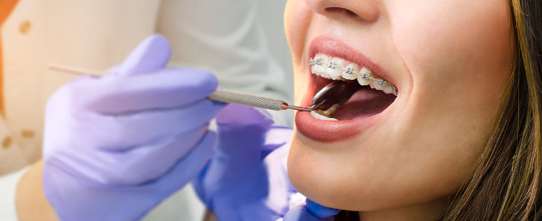 Sí soy adulto ¿la ortodoncia es para mi?