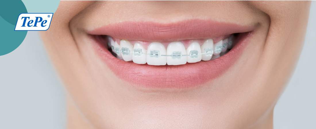 Todo lo que necesitas saber sobre la ortodoncia y sus cuidados a seguir.