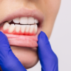 Evitar lesiones en el cepillado dental