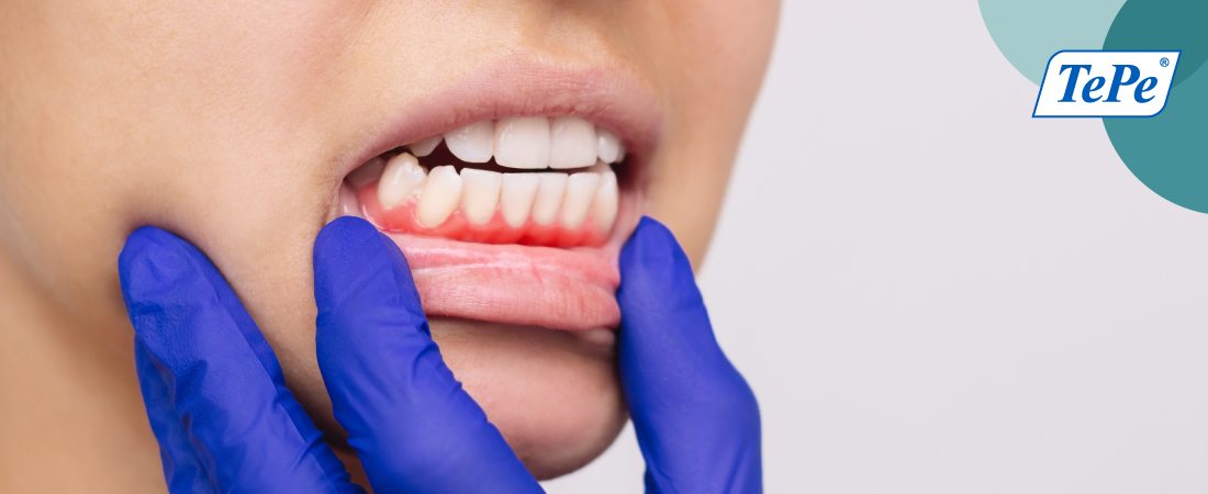 ¿Cómo evitar lesiones en las encías durante el cepillado dental?